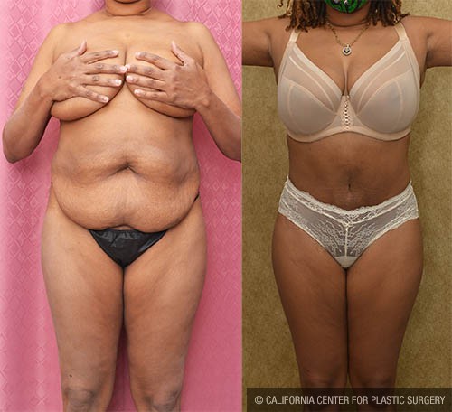 Tummy Tuck (Abdominoplasty) Small Size Before & After Patient #12835