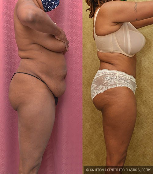 Tummy Tuck (Abdominoplasty) Small Size Before & After Patient #12835