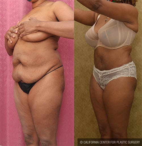 Tummy Tuck (Abdominoplasty) Small Size Before & After Patient #12835