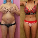 Tummy Tuck (Abdominoplasty) Small Size Before & After Patient #12876