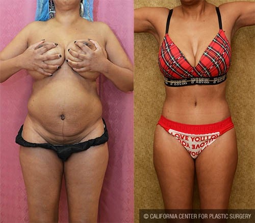Tummy Tuck (Abdominoplasty) Small Size Before & After Patient #12876