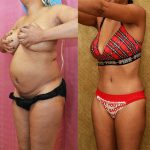 Tummy Tuck (Abdominoplasty) Small Size Before & After Patient #12876