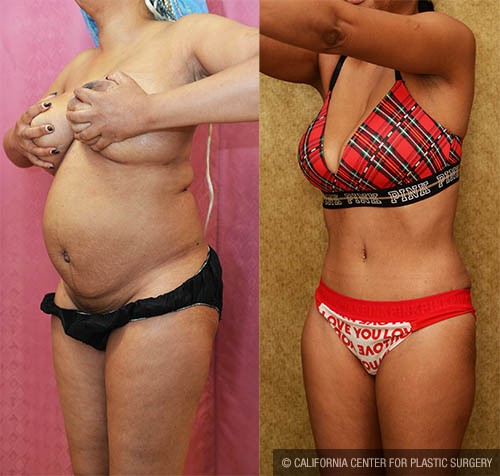 Tummy Tuck (Abdominoplasty) Small Size Before & After Patient #12876