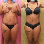 Tummy Tuck (Abdominoplasty) Small Size Before & After Patient #12849