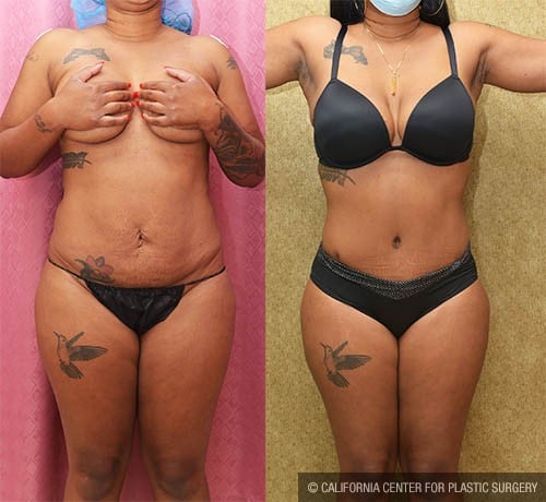 Tummy Tuck (Abdominoplasty) Small Size Before & After Patient #12849