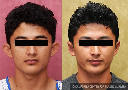 Ear (Otoplasty) Before & After Patient #12884