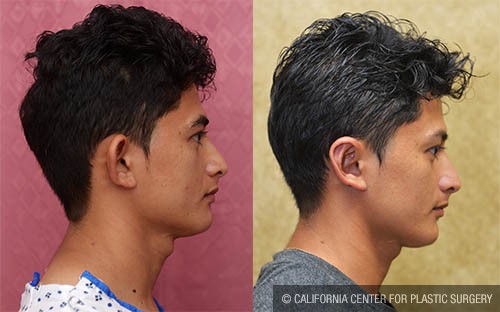 Ear (Otoplasty) Before & After Patient #12884