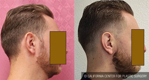 Ear (Otoplasty) Before & After Patient #12885