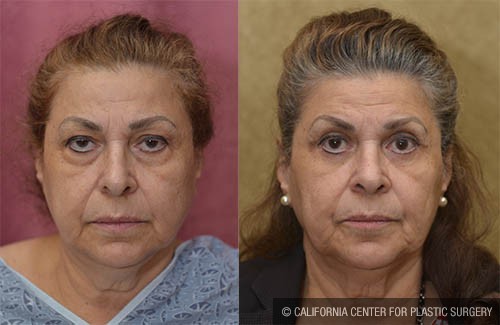 Eyelid (Blepharoplasty) Before & After Patient #12772