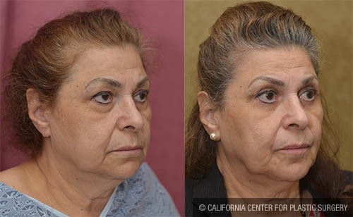 Eyelid (Blepharoplasty) Before & After Patient #12772