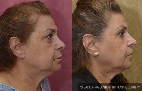 Eyelid (Blepharoplasty) Before & After Patient #12886
