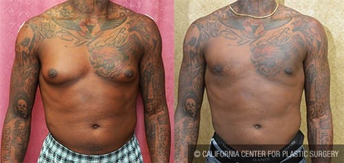 Male gynecomastia (breast) reduction Before & After Patient #12787