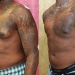 Male gynecomastia (breast) reduction Before & After Patient #12787