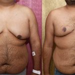 Male gynecomastia (breast) reduction Before & After Patient #12791