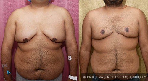 Male gynecomastia (breast) reduction Before & After Patient #12791