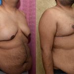 Male gynecomastia (breast) reduction Before & After Patient #12791