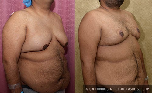 Male gynecomastia (breast) reduction Before & After Patient #12791