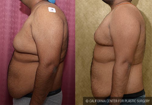 Male gynecomastia (breast) reduction Before & After Patient #12791