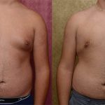 Male gynecomastia (breast) reduction Before & After Patient #12797