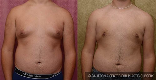 New technique retains nipple color in men after breast reduction