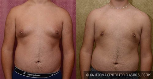 Male gynecomastia (breast) reduction Before & After Patient #12797