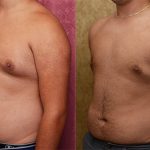 Male gynecomastia (breast) reduction Before & After Patient #12797