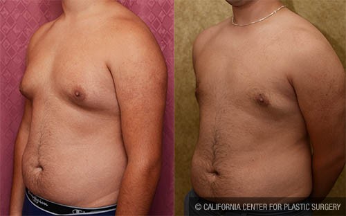 Male gynecomastia (breast) reduction Before & After Patient #12797