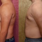 Male gynecomastia (breast) reduction Before & After Patient #12797