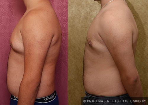 Male gynecomastia (breast) reduction Before & After Patient #12797