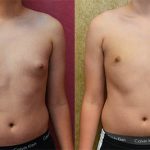 Male gynecomastia (breast) reduction Before & After Patient #12800