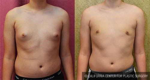 Male gynecomastia (breast) reduction Before & After Patient #12800