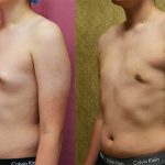 Male gynecomastia (breast) reduction Before & After Patient #12800