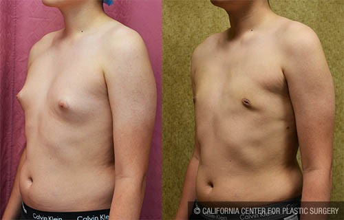 Male gynecomastia (breast) reduction Before & After Patient #12800