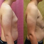 Male gynecomastia (breast) reduction Before & After Patient #12800