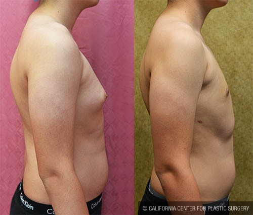 Male gynecomastia (breast) reduction Before & After Patient #12800