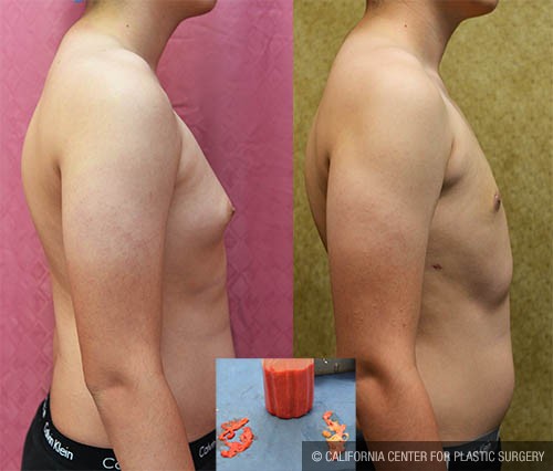 Male gynecomastia (breast) reduction Before & After Patient #12800