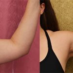 Liposuction Arms Before & After Patient #12751