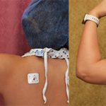 Liposuction Arms Before & After Patient #12751