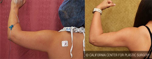 Liposuction Arms Before & After Patient #12751