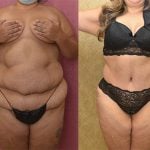 Liposuction Abdomen Plus Size Before & After Patient #12808