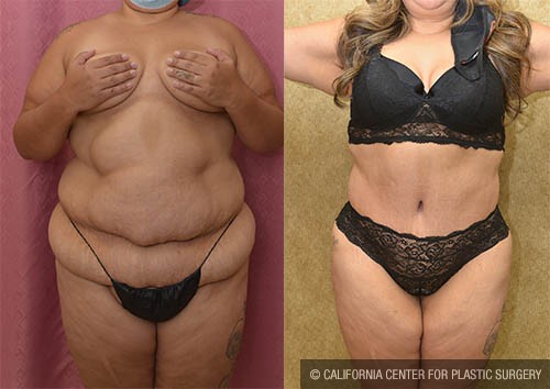 Liposuction Abdomen Plus Size Before & After Patient #12808