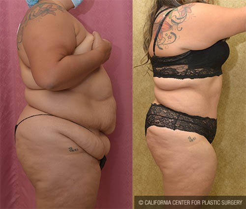Liposuction Abdomen Plus Size Before & After Patient #12808