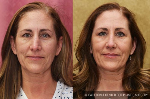 Rhinoplasty - Caucasian Before & After Patient #12811