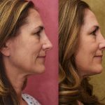 Rhinoplasty - Caucasian Before & After Patient #12811