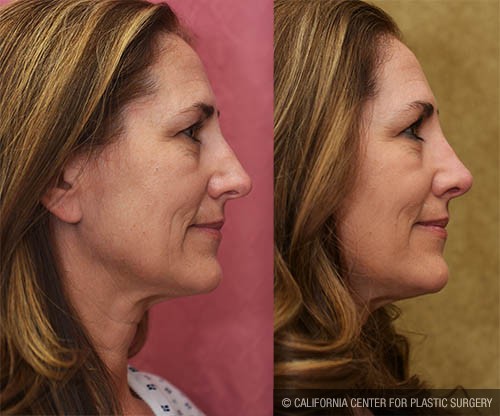 Rhinoplasty - Caucasian Before & After Patient #12811