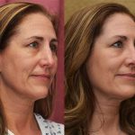 Rhinoplasty - Caucasian Before & After Patient #12811