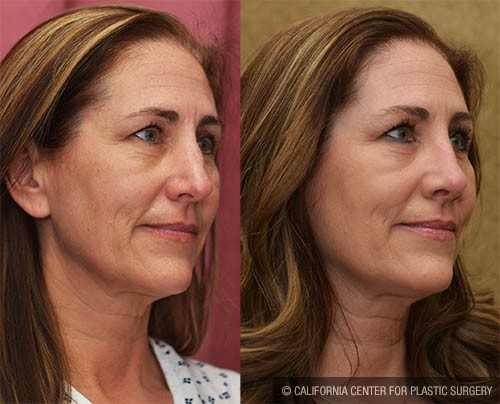 Rhinoplasty - Caucasian Before & After Patient #12811