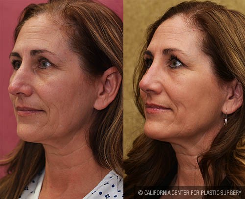 Rhinoplasty - Caucasian Before & After Patient #12811