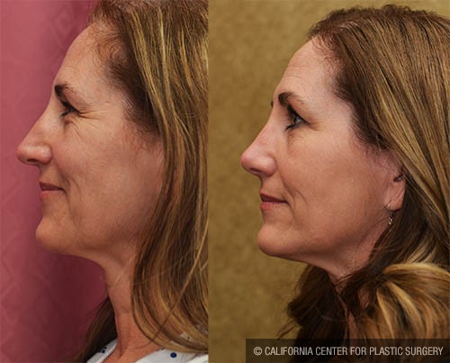 Rhinoplasty - Caucasian Before & After Patient #12811