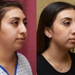 Rhinoplasty - Middle Eastern Before & After Patient #12825